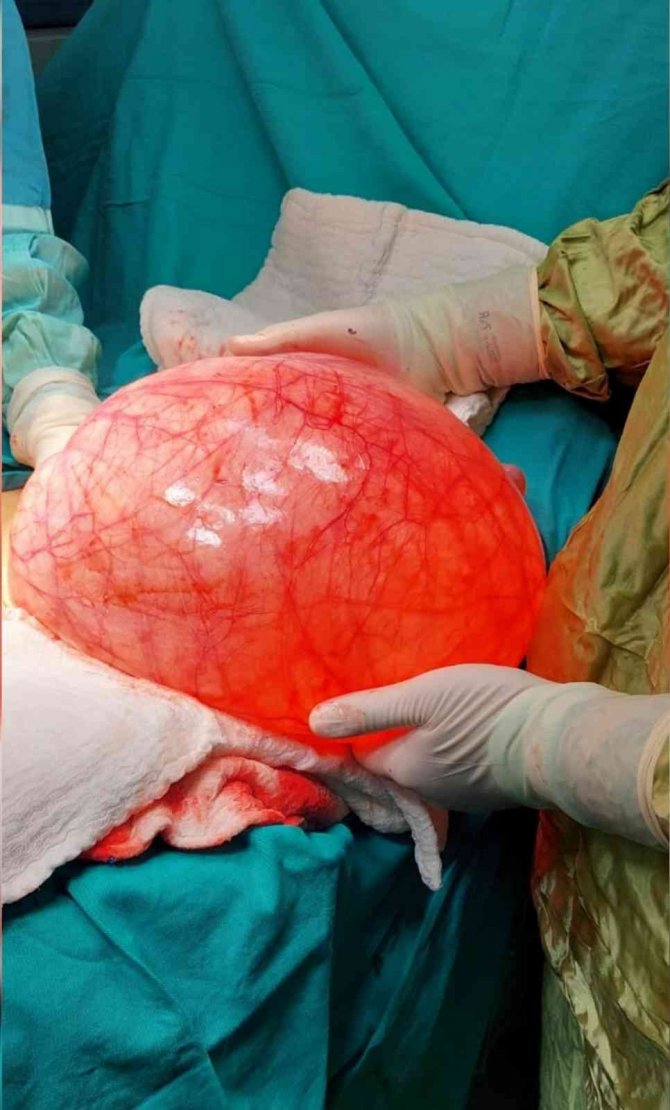 30 Santimetrelik Yumurtalık Tümörü Başarılı Bir Operasyonla Çıkartıldı