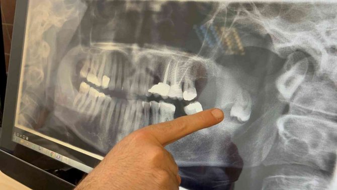 Kalıcı Yüz Felci Olmaktan Bu Operasyonla Kurtuldu