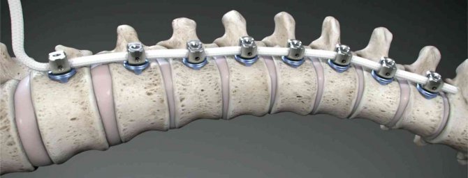 ’’İ̇pli Skolyoz Tedavisinde İlk Gerdirmede Eğriliğin Yüzde 60-80’i Düzeltilir’’