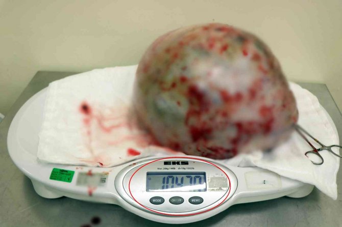Genç Kadının Karnından 11 Kiloya Yakın Kitle Çıktı