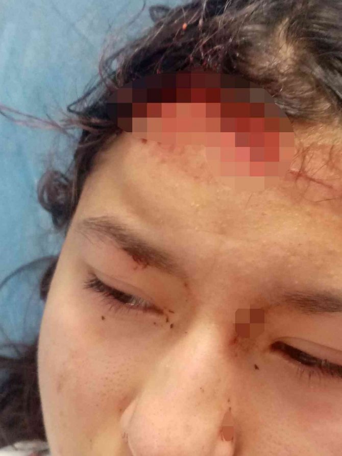 Öz Çekim Yaparken Sokak Köpeklerinin Saldırısına Uğrayan Çocuk Ölümden Döndü