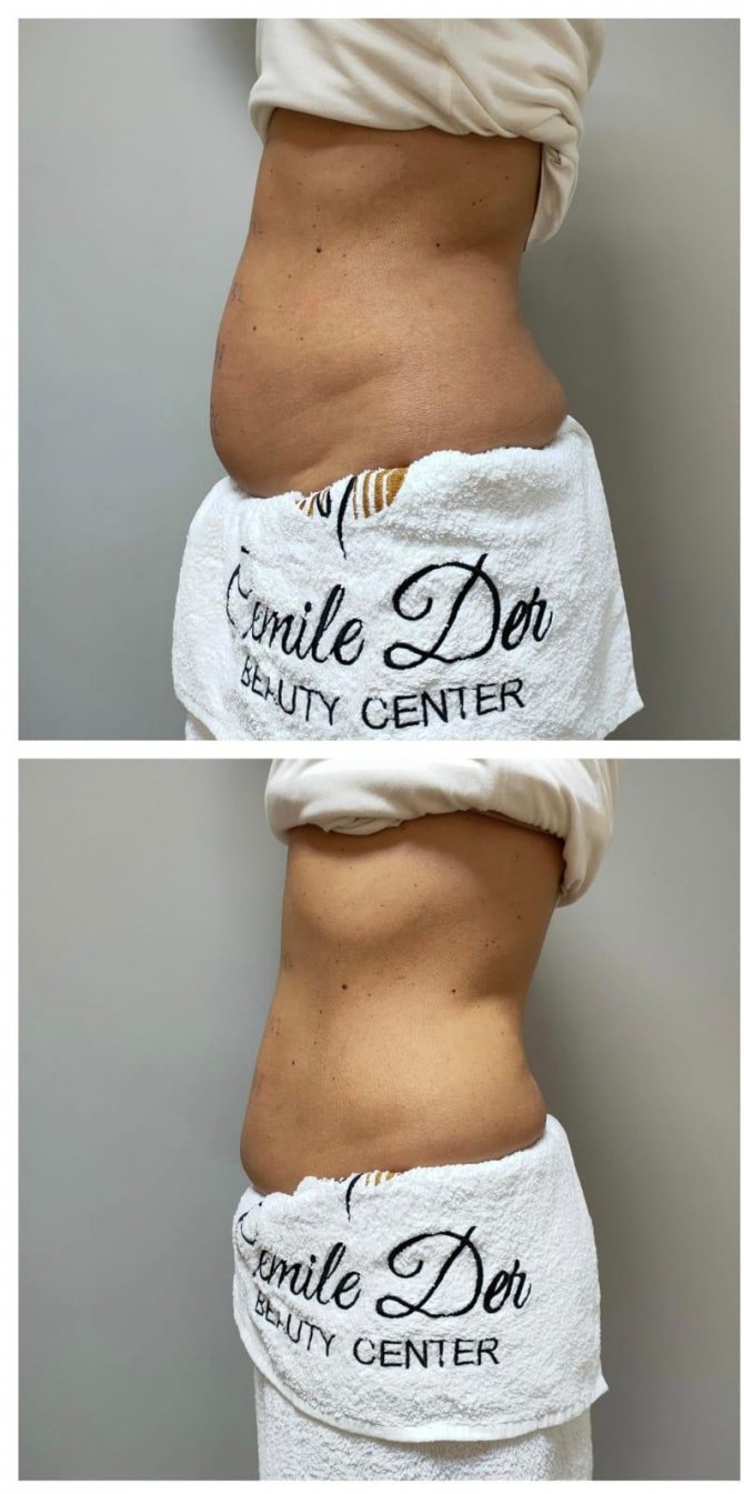 Dirençli Yağlara Tek Seansta Veda