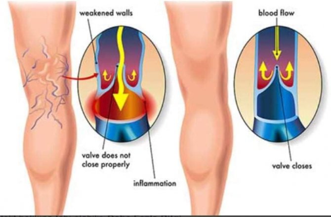 İ̇negöl Devlet Hastanesinde İlk Kez Kapalı Varis Ameliyatı Yapıldı