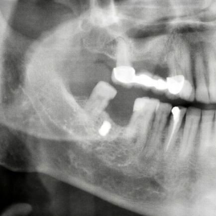 Damağına Saplanan Kurşun Büyüklüğündeki Demir Parçasından 15 Yıl Sonra Haberdar Oldu