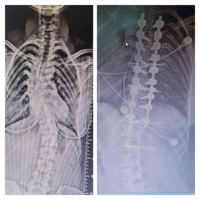 Balıkesir Atatürk Şehir Hastanesi’nde Bir İlk Daha