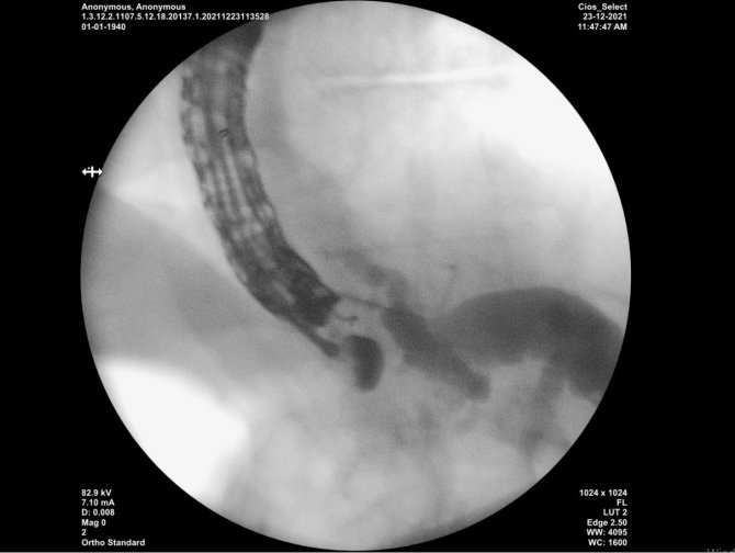 Kayseri Şehir Hastanesi’nde İlk; Ameliyatsız, Endoskopik Ultrasonla Safra Yolu Boşaltıldı