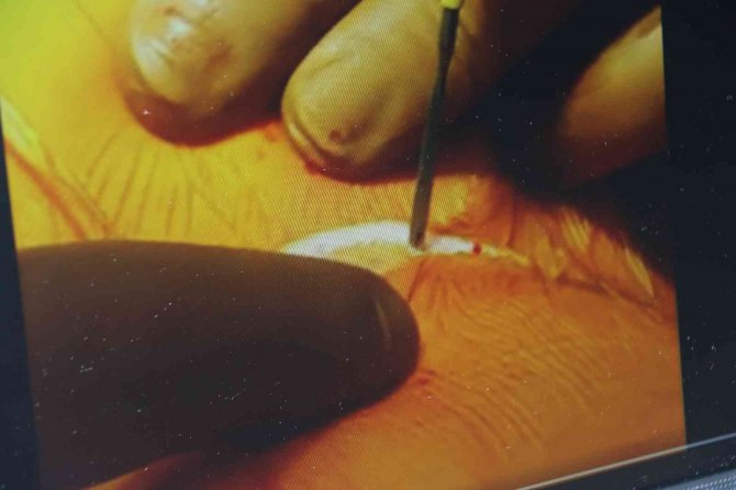 ’Küçük Kesi’ Ameliyatlarında İyileşme Süresi Kısa, Kozmetik Avantajı Yüksek, Daha Az Yara İzi