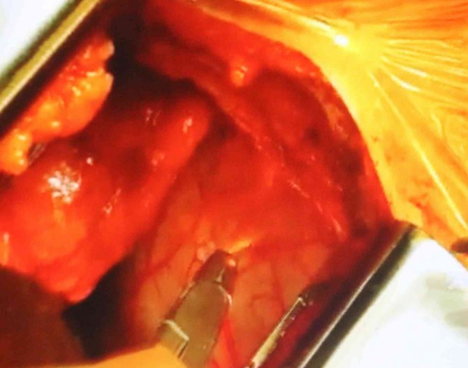 ’Küçük Kesi’ Ameliyatlarında İyileşme Süresi Kısa, Kozmetik Avantajı Yüksek, Daha Az Yara İzi