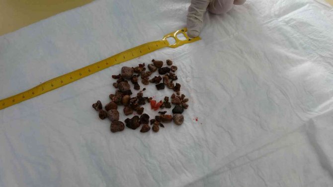 Böbrek Taşlarından Kurtuldu Sağlığına Kavuştu