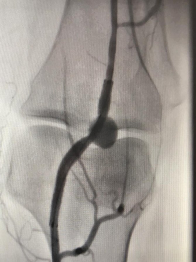 Elbistan Devlet Hastanesi’nde İlk Stent Uygulaması Yapıldı