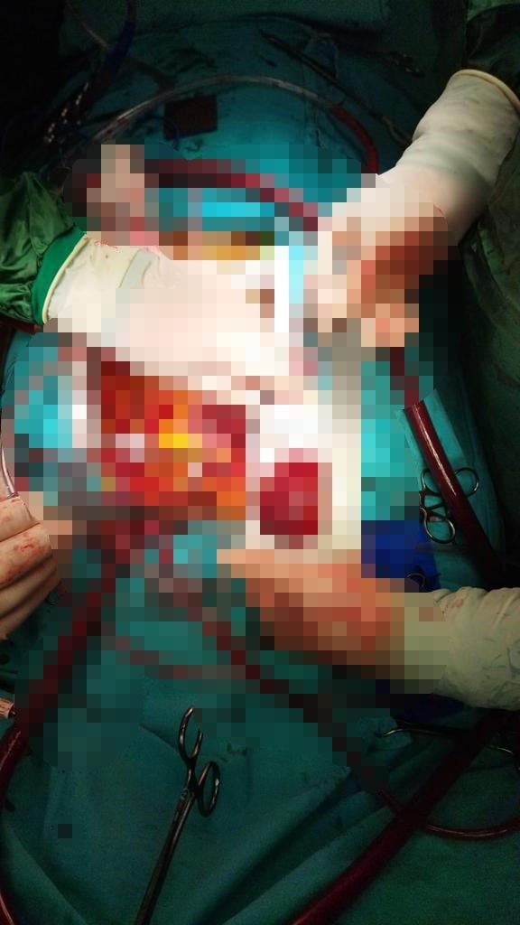 Kontrolleri Aksattı Kalbinde Portakal Büyüklüğünde Tümör Çıktı
