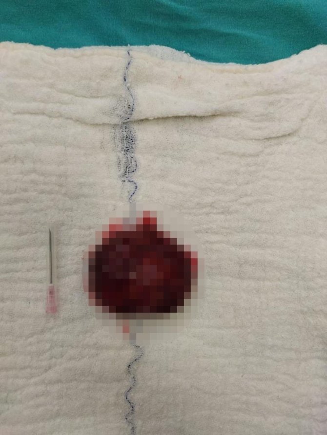 Kontrolleri Aksattı Kalbinde Portakal Büyüklüğünde Tümör Çıktı