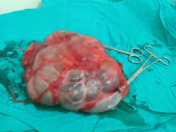 Karnında Şişlik Olan Hastanın Büyüyerek 25 Santim Olan Böbreği Alındı