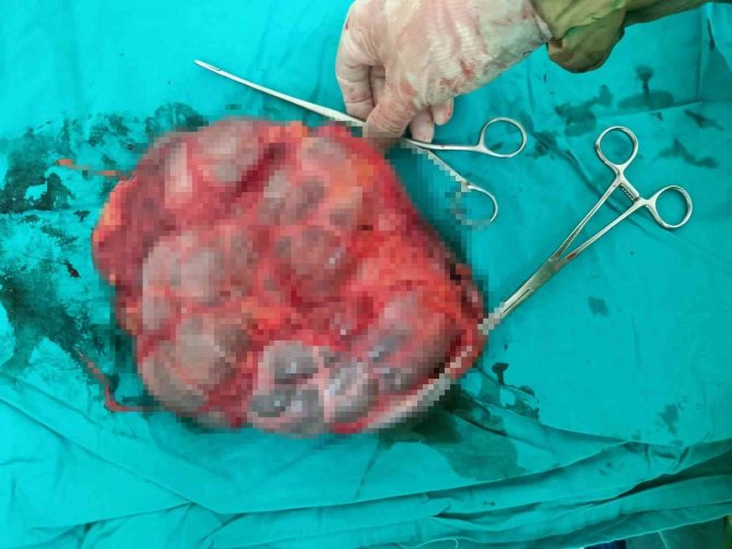 Karnında Şişlik Olan Hastanın Büyüyerek 25 Santim Olan Böbreği Alındı