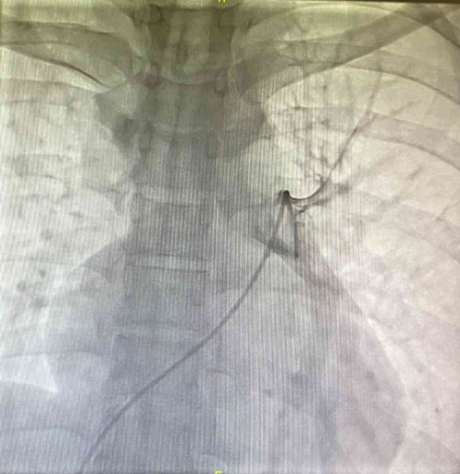 Manisa’da Bir İlk: Ölümcül Akciğer Pıhtısına Anjiyografi İle Müdahale