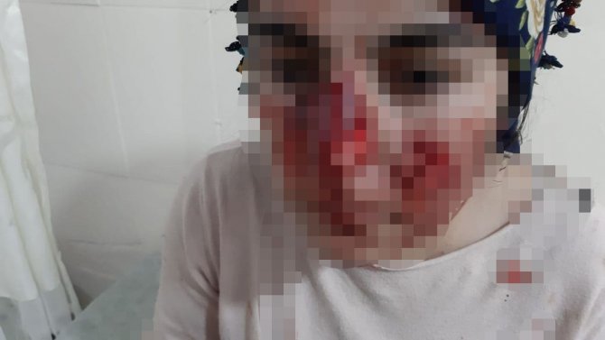 Mardin’de Sokak Köpeği Vahşeti: Vatandaşların Yüzleri Parçalandı