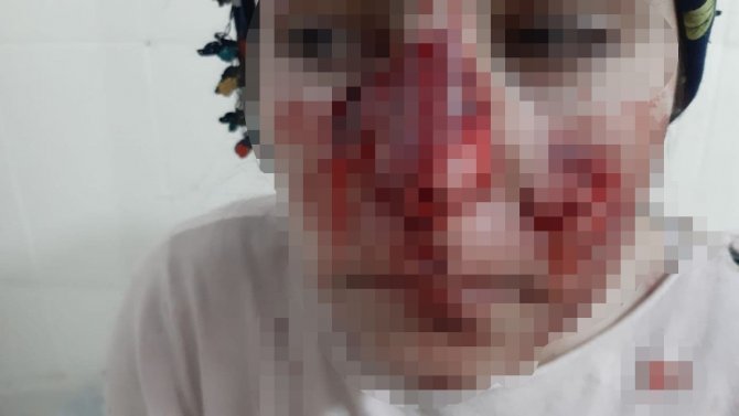 Mardin’de Sokak Köpeği Vahşeti: Vatandaşların Yüzleri Parçalandı