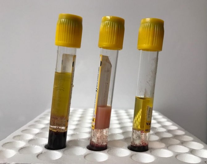 Kolesterolün Önemi Kanda Ortaya Çıktı: Düşükte Kan Berrak, Yüksekte Bulanık Ve Katı