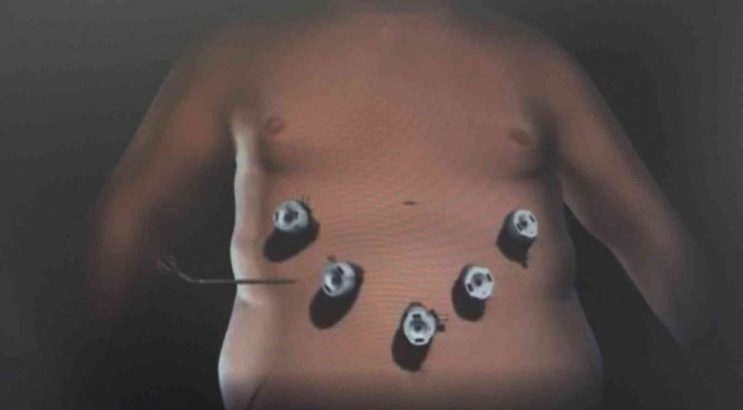 Obeziteye Bağlı Ölümler Sigara Nedenli Ölümleri Geride Bıraktı