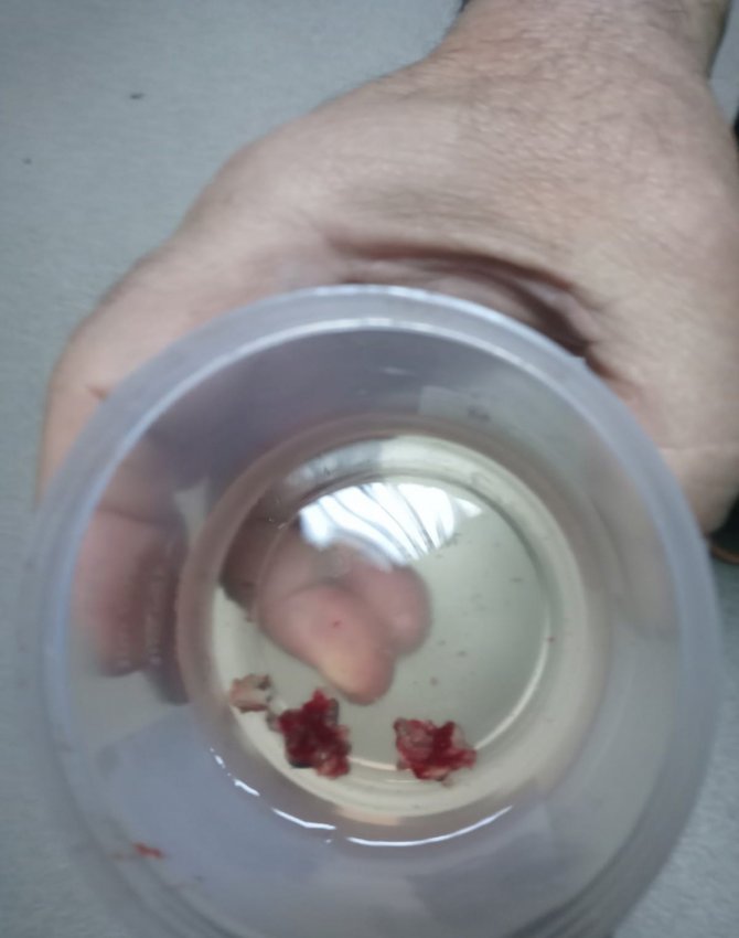 Baş Ağrısı Şikayetiyle Hastaneye Gitti Burnundan Taş Çıktı