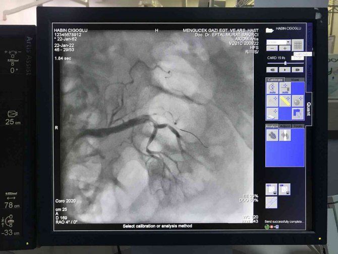 Erzincan’da, İlk Böbrek Anjiyosu Yapıldı