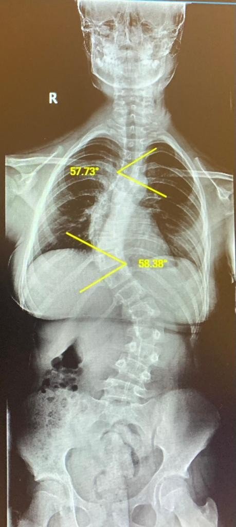 Çocukları Hızlı Boy Atan Aileler Dikkat