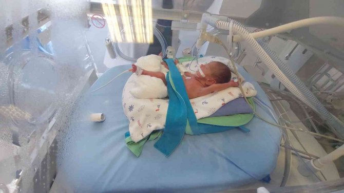 495 Gramlık Prematüre Bebeğe Kök Hücre Nakli Yapıldı