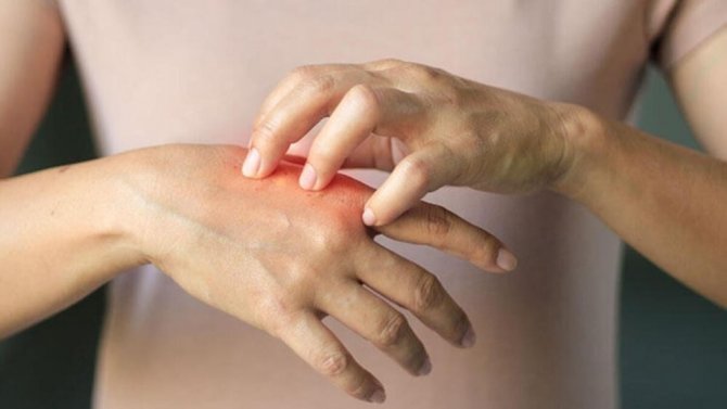 Soğuk Yanıklarına Dikkat; Kaşınma, Morarma Ve Ağrı Olabilir