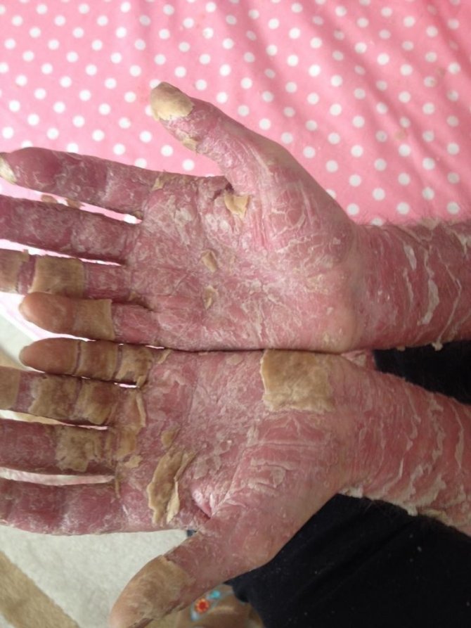 Doç. Dr. Melikoğlu: Sedef Hastalarından Kaçmayın, Bulaşıcı Değil