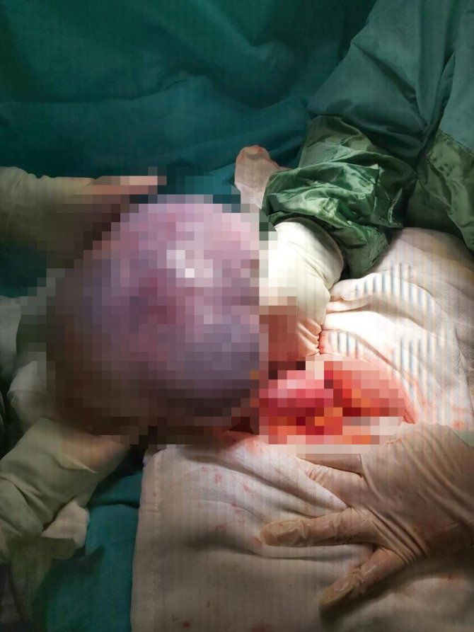 Şiddetli Karın Ağrısı İle Hastaneye Gitti, Karnından 3 Kiloluk Kist Çıktı