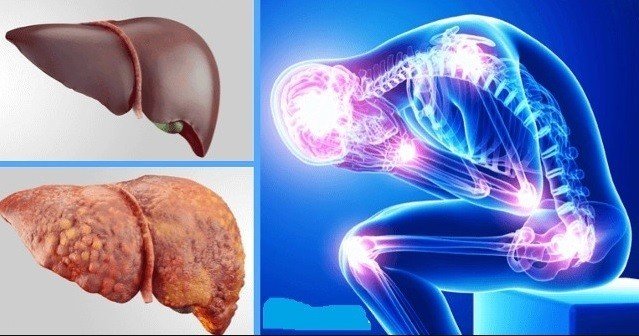 Karaciğer Nakilleri Arttı, Hastalık Önlenebilir