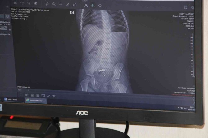 Mıknatıslı Oyuncak Yutan 2,5 Yaşındaki Cemre Ölümden Döndü