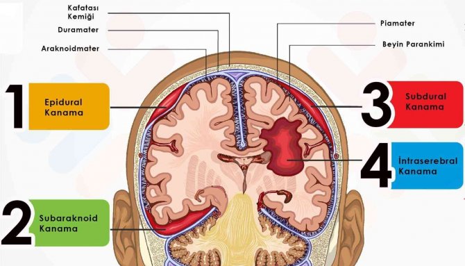 İ̇nsanların Ölümüne Sebep Olan Beyin Kanamasında En Başta Travmalar Geliyor
