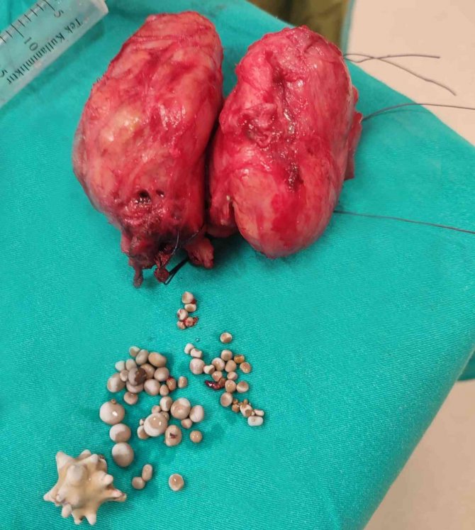 Aydın’dan Denizli Tekden Hastanesi’ne Gelen Hastadan 320 Gram Prostat Çıktı