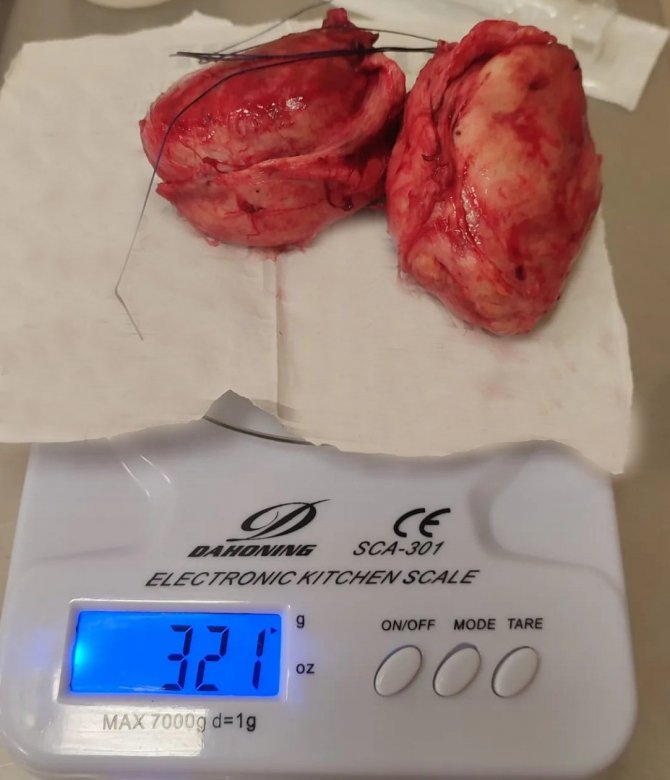 Aydın’dan Denizli Tekden Hastanesi’ne Gelen Hastadan 320 Gram Prostat Çıktı