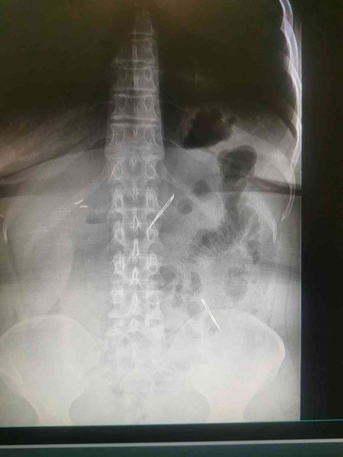 Karın Ağrısı Şikayetiyle Gitti, 2 Tane Neşter Yuttuğunu Öğrendi