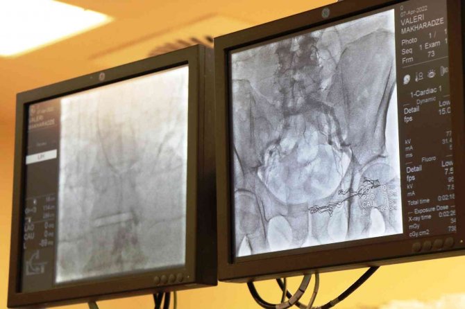 Gürcistan’da Ölümü Beklenen Hasta Samsun’da Sağlığına Kavuştu