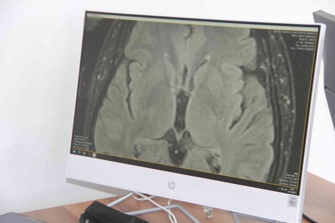 Beyin Cerrahisi ’Parkinson’a Tedavi İmkanı Sunuyor