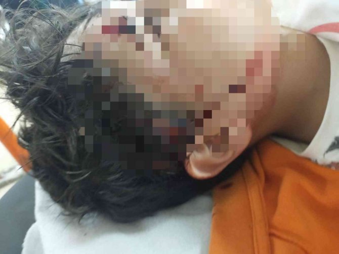 Okula Giden 10 Yaşındaki Çocuğa Başıboş 8 Köpek Saldırdı, 80 Dikiş Atıldı