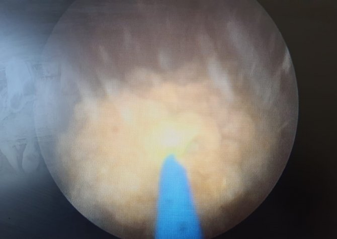 22 Mm Mesane Taşından Kurtulan Çocuk Sağlığına Kavuştu