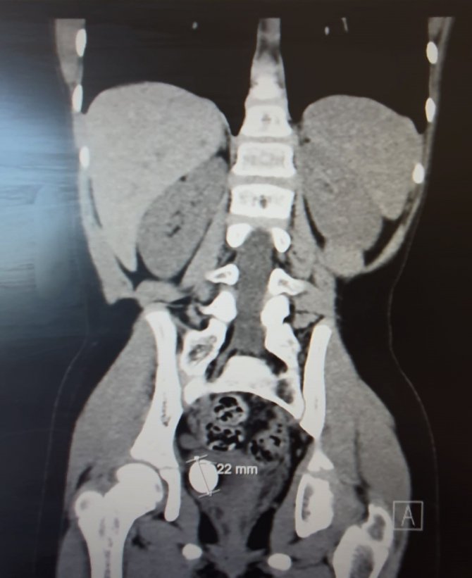 22 Mm Mesane Taşından Kurtulan Çocuk Sağlığına Kavuştu