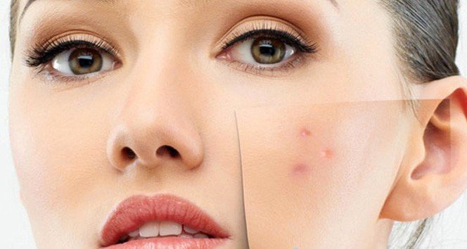 Hassas Ve Alerjik Ciltlere Mevsim Geçişlerinde Dikkat