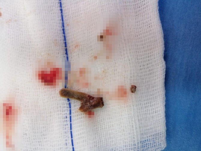 Öksürük Şikayetiyle Gittiği Hastanede 5 Yıldır Akciğerinde Lades Kemiğiyle Yaşadığını Öğrendi