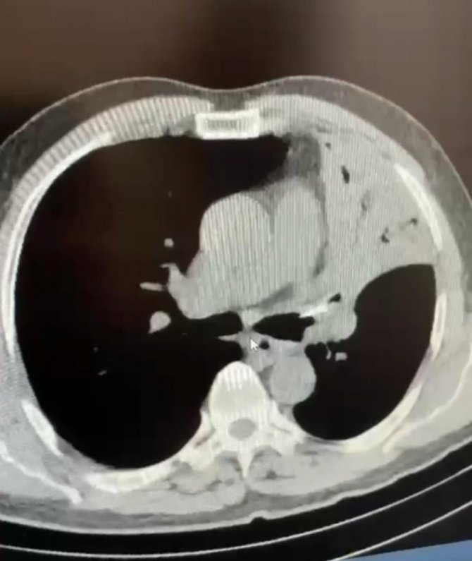 Öksürük Şikayetiyle Gittiği Hastanede 5 Yıldır Akciğerinde Lades Kemiğiyle Yaşadığını Öğrendi