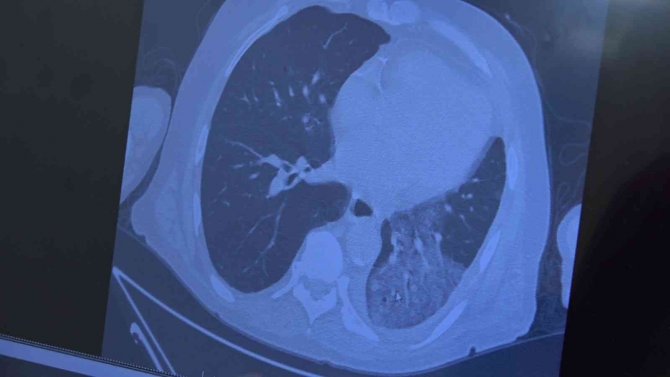 Prof. Dr. Özkaya: “Bayramda Vaka Artışı Bekliyoruz”