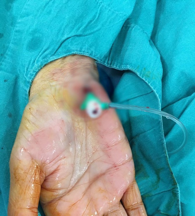 Elazığ Fethi Sekin Şehir Hastanesinde Anjiyografi Yöntemi İle Tıkalı Damar Açıldı