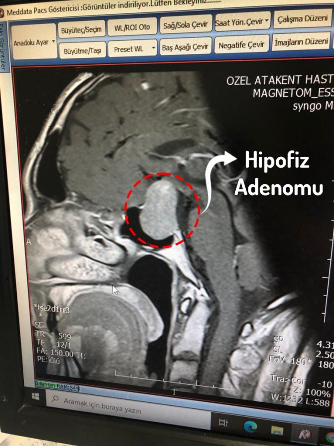 Yalova’da İ̇lk Kez Özel Atakent Hastanesi’nde Kapalı Yöntemle Endoskopik Hipofiz Cerrahisi Uygulandı