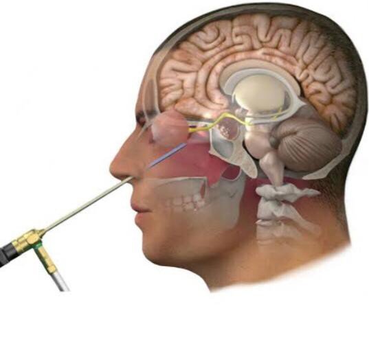 Yalova’da İ̇lk Kez Özel Atakent Hastanesi’nde Kapalı Yöntemle Endoskopik Hipofiz Cerrahisi Uygulandı