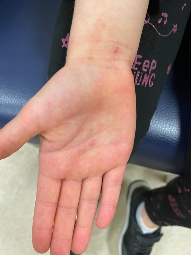 Bayram Tatilinde Çam Kese Böceğine Dikkat