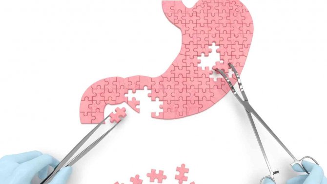 Cerrahi Yöntemler Obezite İle Mücadelede Önemli Rol Oynuyor